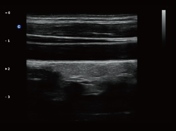 Chison QBit-3 Ultrasound Machine