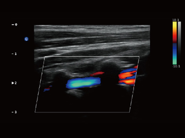 Chison QBit-3 Ultrasound Machine Chison QBit-3 Ultrasound Machine