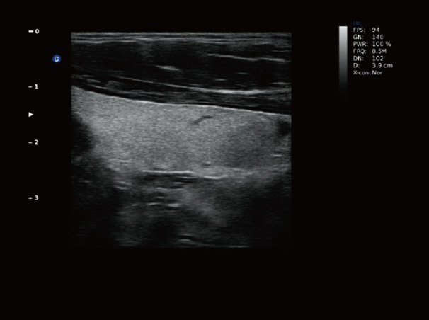 Chison QBit-3 Ultrasound Machine Chison QBit-3 Ultrasound Machine