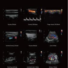 Chison Qbit 3 Color Doppler Digital Ultrasound Machine - Image 5