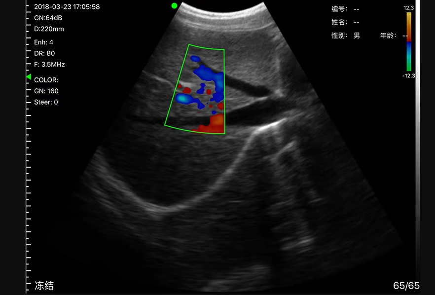 Wireless Color Doppler Ultrasound
