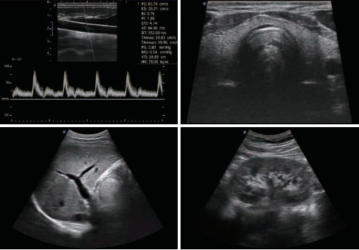 Sonoscape E1 Ultrasound machine